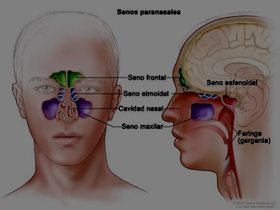 Sinusitis aguda