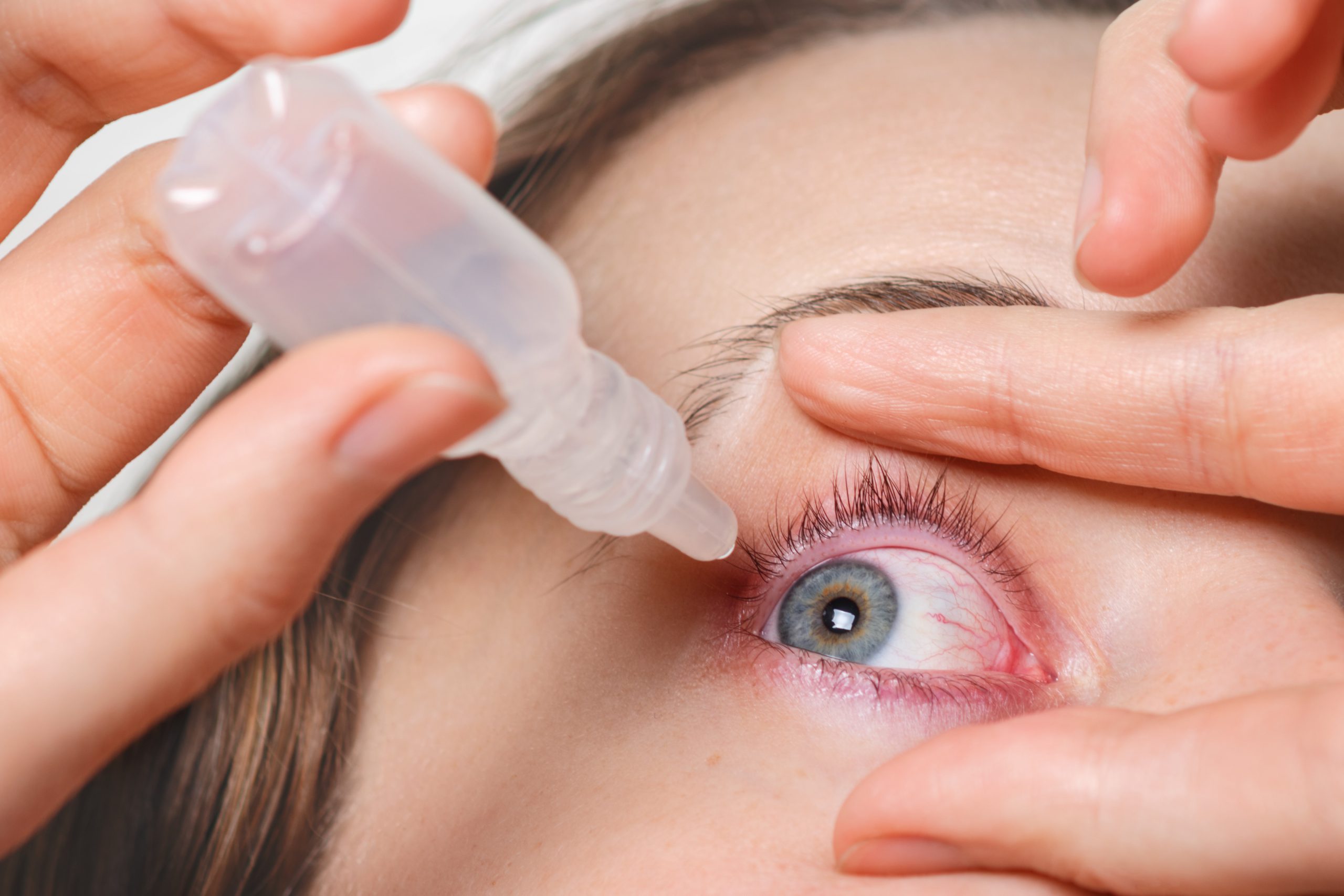 Conjuntivitis, enfermedad de la conjuntiva